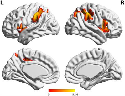 Language Network Function in Young Children Born Very Preterm